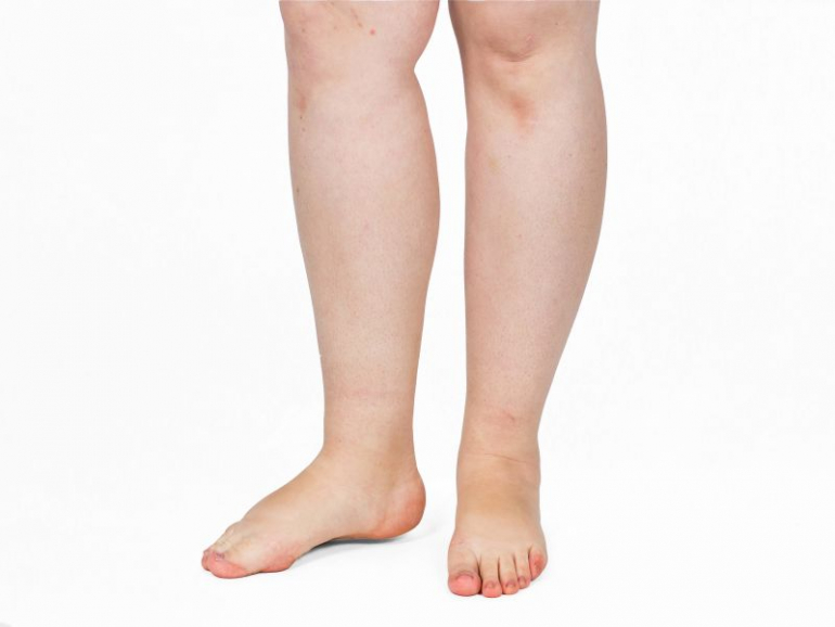 脚の太い人は高血圧になりにくい可能性 米ニュージャージーメディカルスクール研究報告 Dime アットダイム