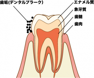 なぜマイナスイオンの歯ブラシで歯垢が落ちるのか!?