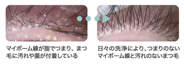 まつ毛ダニ 安い マイボーム腺