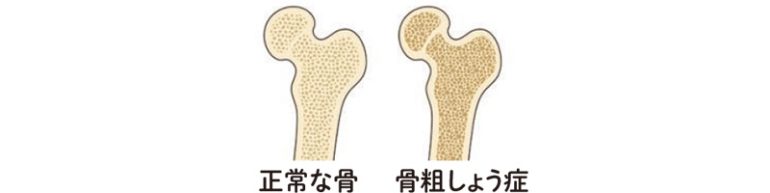 骨粗しょう症ドック