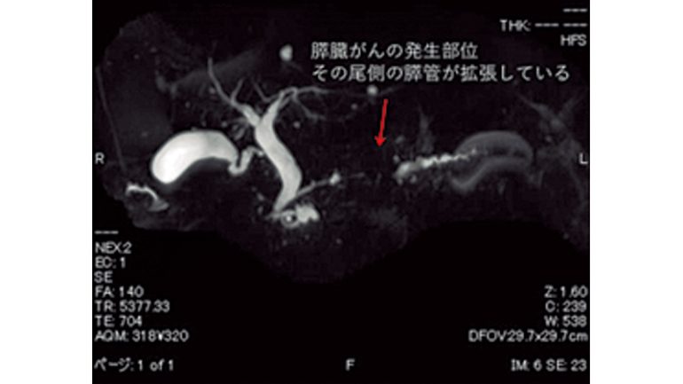 MRICP検査