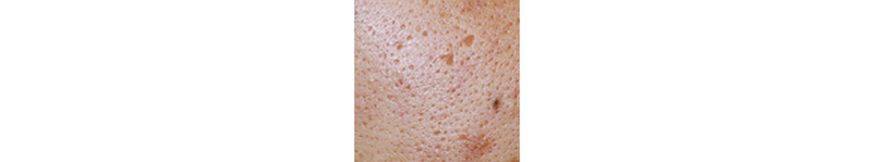 クレーター毛穴