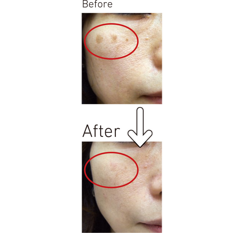 Qスイッチルビーレーザー