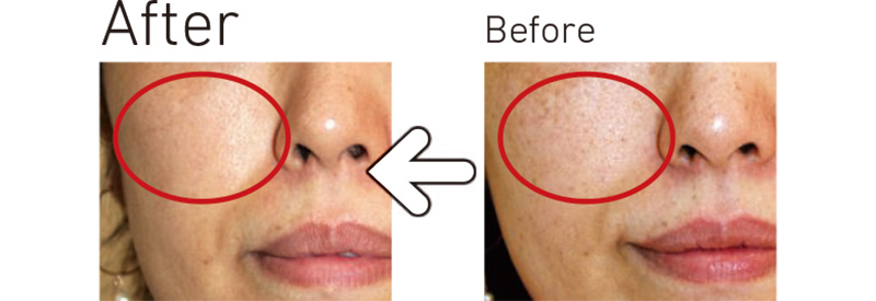 Qスイッチヤグレーザー