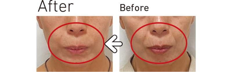 ヒアルロン酸注入