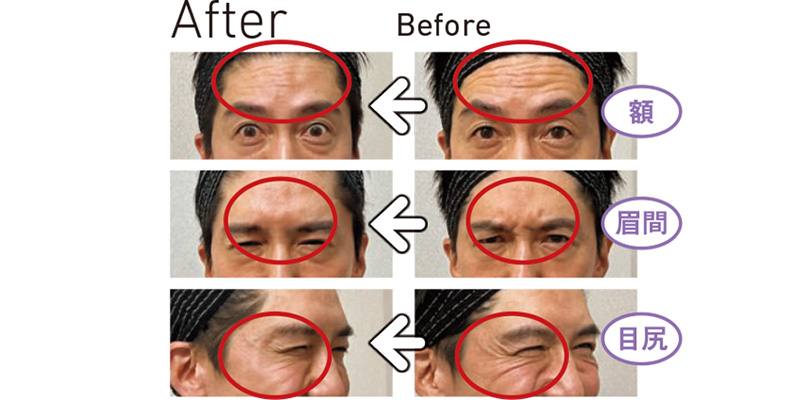 ボトックス注射