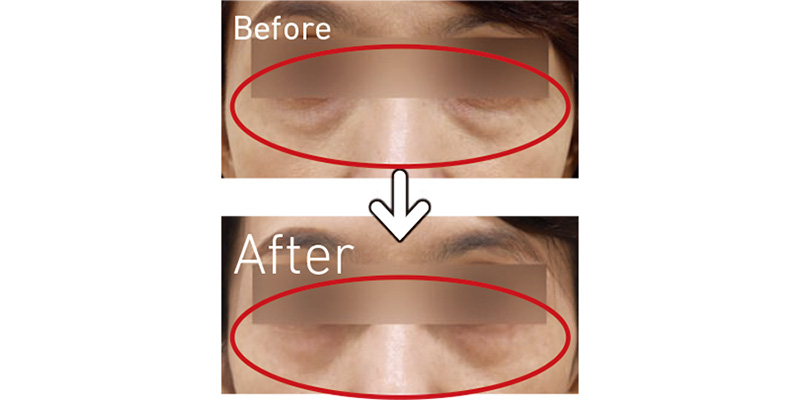 眼窩（がんか）脂肪溶解注射