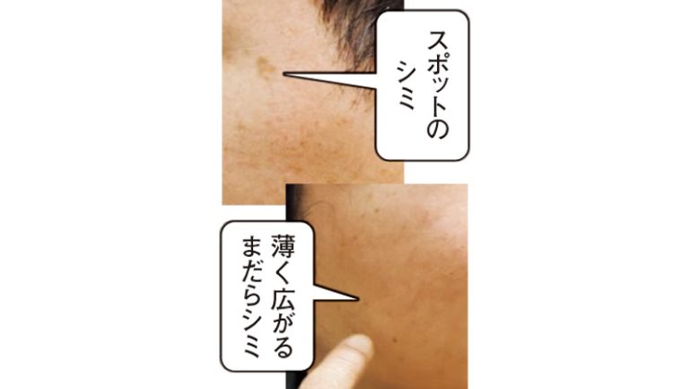 シミ