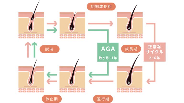 そもそもAGAって何?