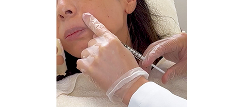 ヒアルロン酸注入