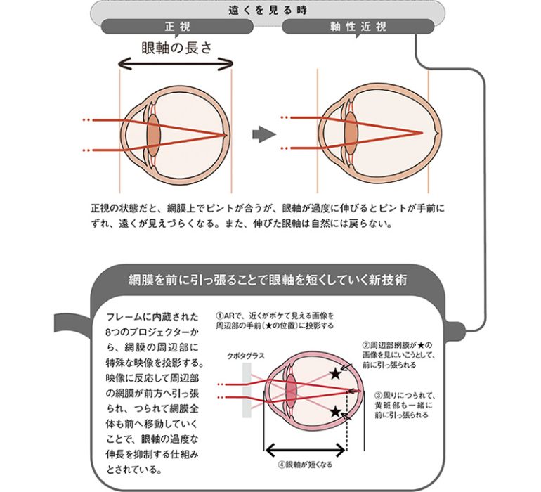 眼軸が伸びることで進行する近視のメカニズムとは?
