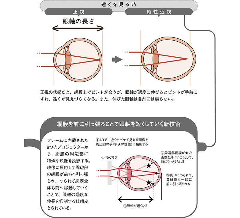 眼軸が伸びることで進行する近視のメカニズムとは？